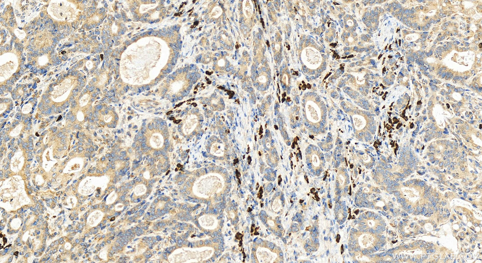 Immunohistochemistry (IHC) staining of human stomach cancer tissue using SPCS2 Polyclonal antibody (14872-1-AP)