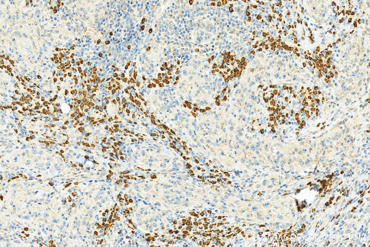 Immunohistochemistry (IHC) staining of human skin cancer tissue using SPCS2 Polyclonal antibody (14872-1-AP)