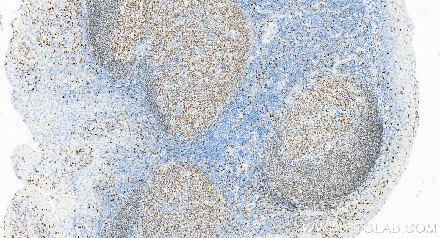 Immunohistochemistry (IHC) staining of Human tonsillitis tissue using SPI1 Monoclonal antibody (66618-2-Ig)