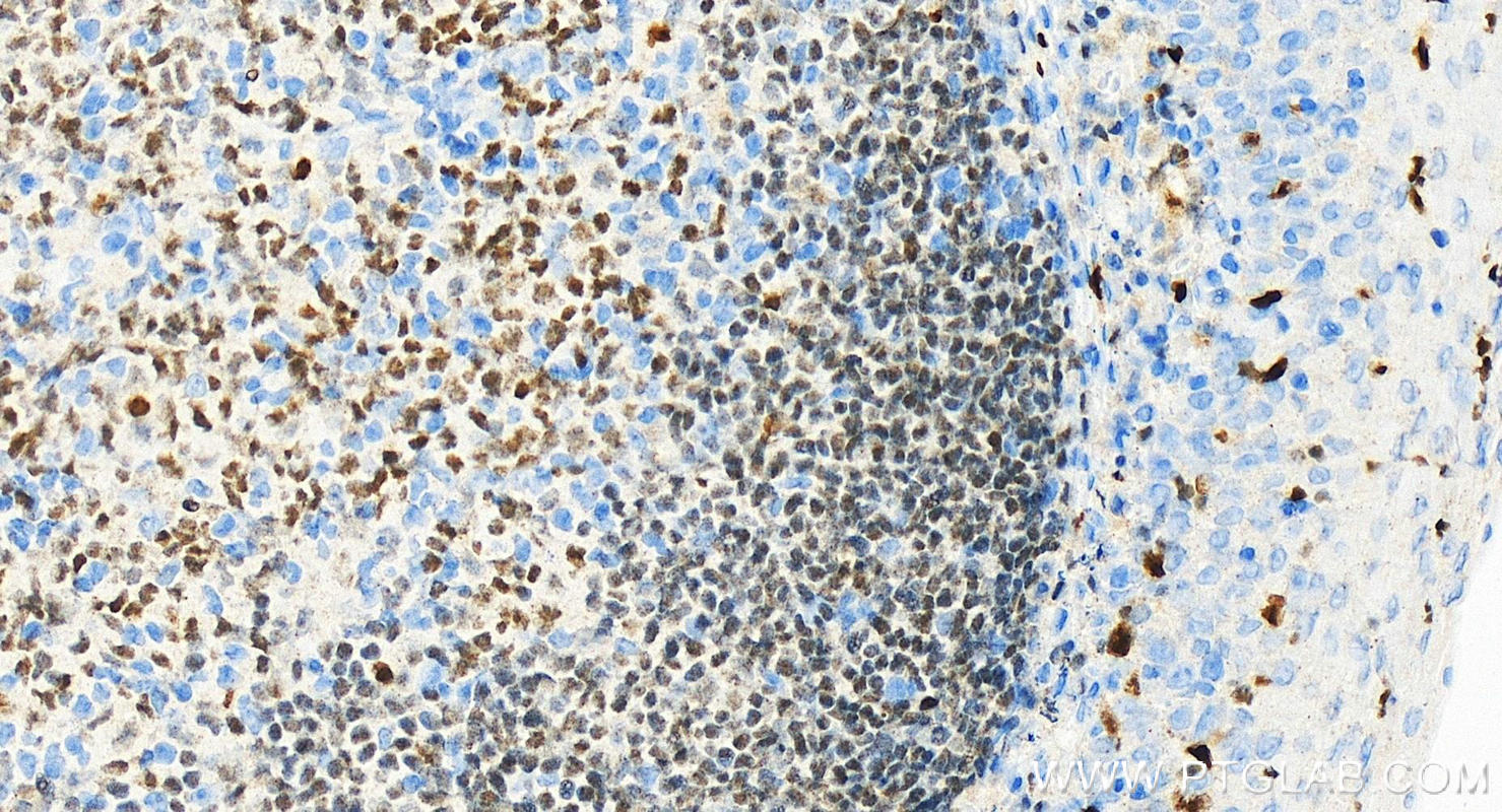 Immunohistochemistry (IHC) staining of Human tonsillitis tissue using SPI1 Monoclonal antibody (66618-2-Ig)