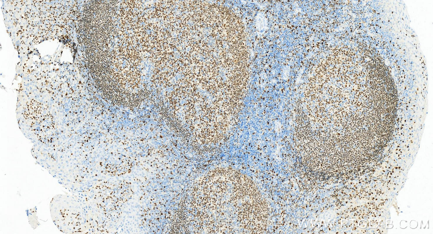 Immunohistochemistry (IHC) staining of Human tonsillitis tissue using SPI1 Monoclonal antibody (66618-2-Ig)