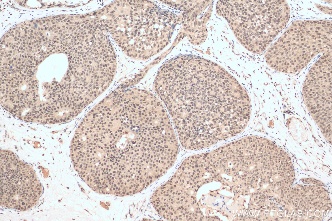 Immunohistochemistry (IHC) staining of human breast cancer tissue using SPIN2B Polyclonal antibody (10107-2-AP)