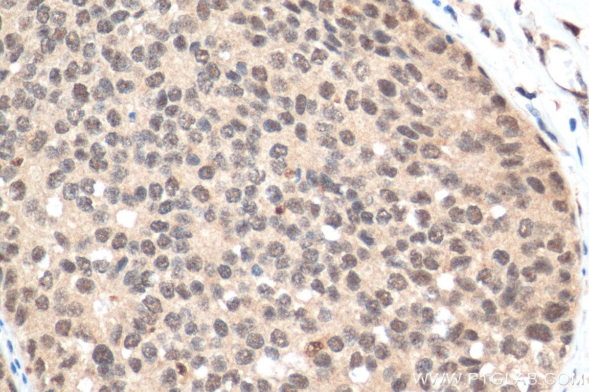 Immunohistochemistry (IHC) staining of human breast cancer tissue using SPIN2B Polyclonal antibody (10107-2-AP)