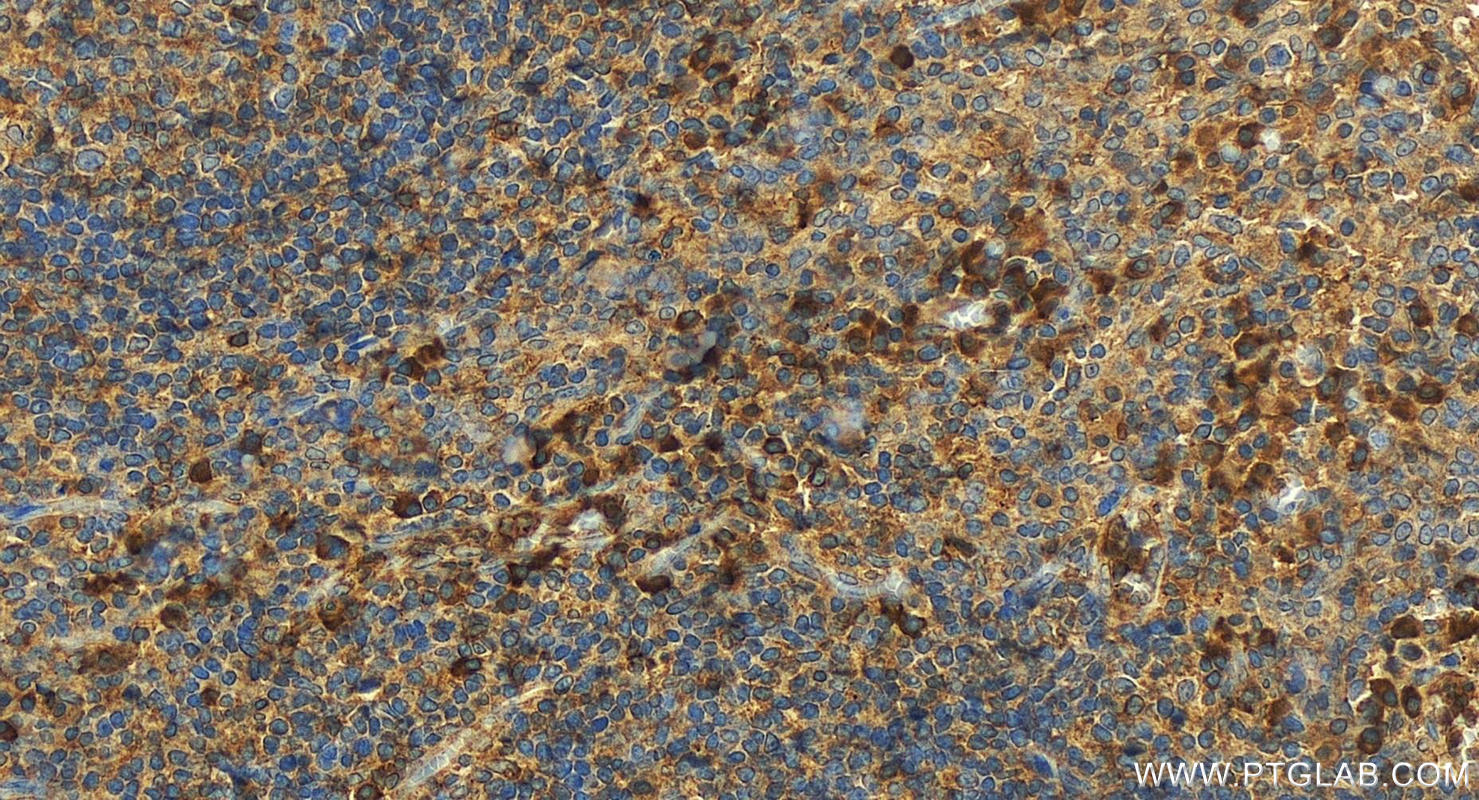 Immunohistochemistry (IHC) staining of human tonsillitis tissue using CD43 Polyclonal antibody (13959-1-AP)