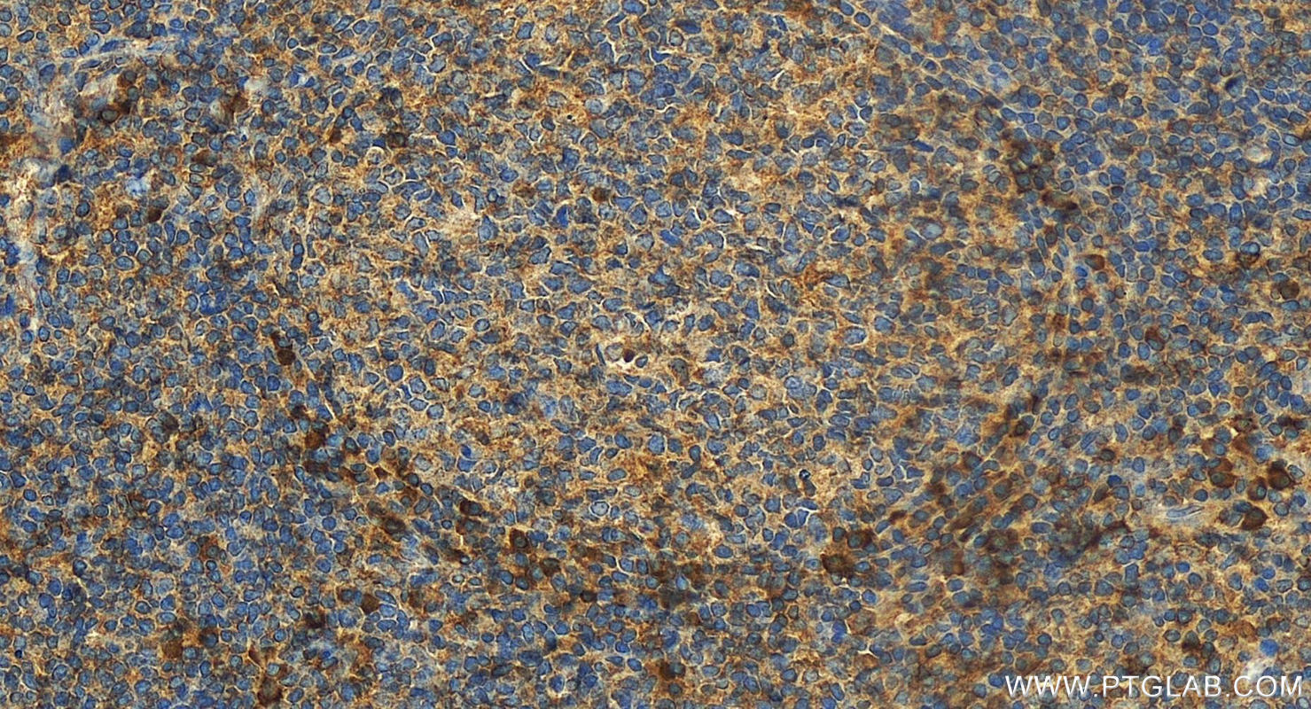 Immunohistochemistry (IHC) staining of human tonsillitis tissue using CD43 Polyclonal antibody (13959-1-AP)