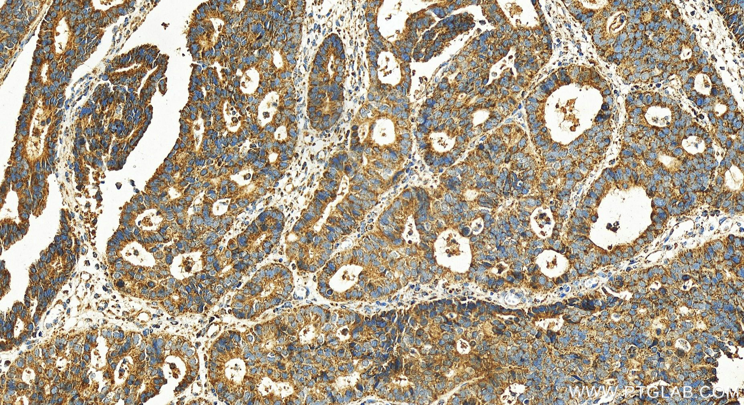 Immunohistochemistry (IHC) staining of human stomach cancer tissue using SPTBN2 Polyclonal antibody (55107-1-AP)