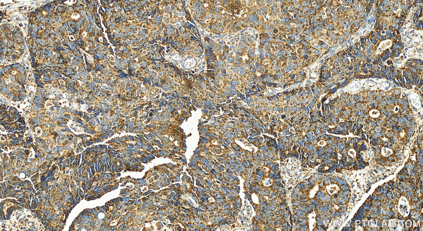 Immunohistochemistry (IHC) staining of human stomach cancer tissue using SPTBN2 Polyclonal antibody (55107-1-AP)