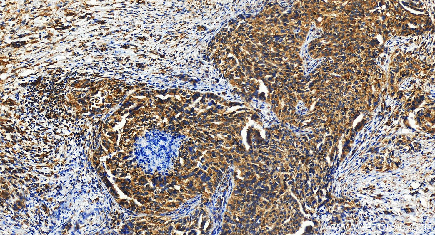 Immunohistochemistry (IHC) staining of human ovary cancer tissue using SPTLC3 Polyclonal antibody (16600-1-AP)