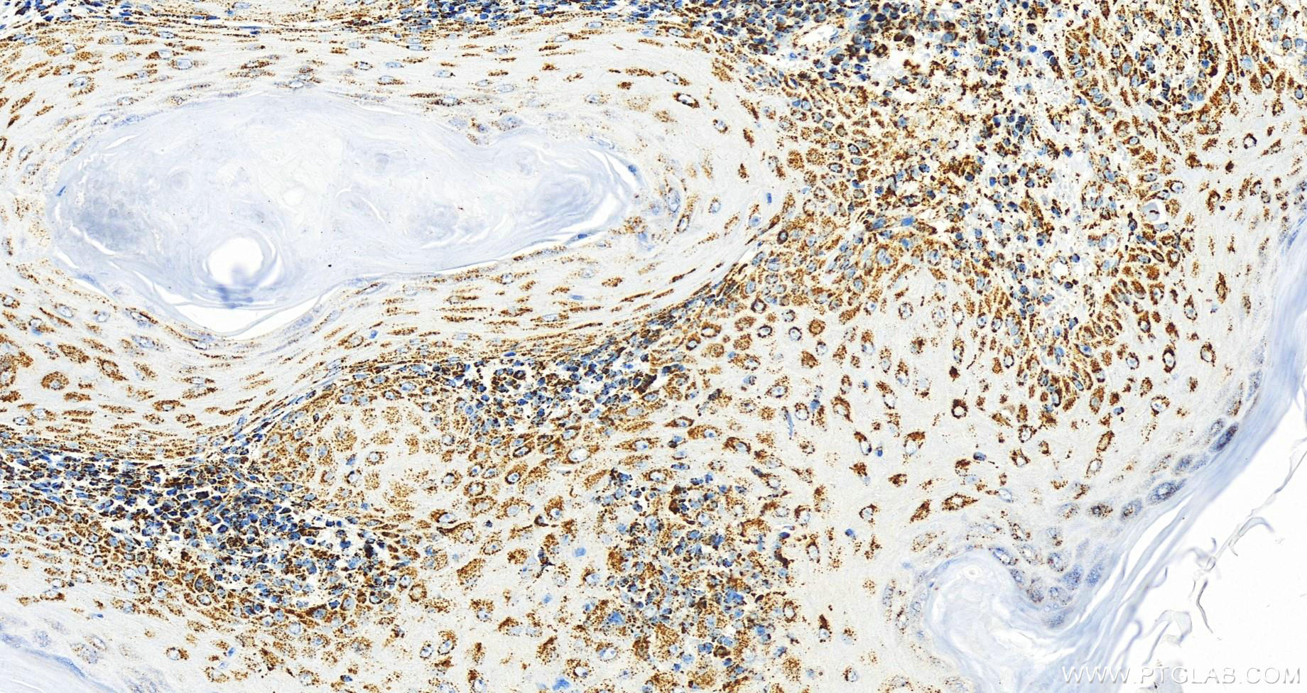 Immunohistochemistry (IHC) staining of human skin cancer tissue using SQRDL Monoclonal antibody (68459-1-Ig)