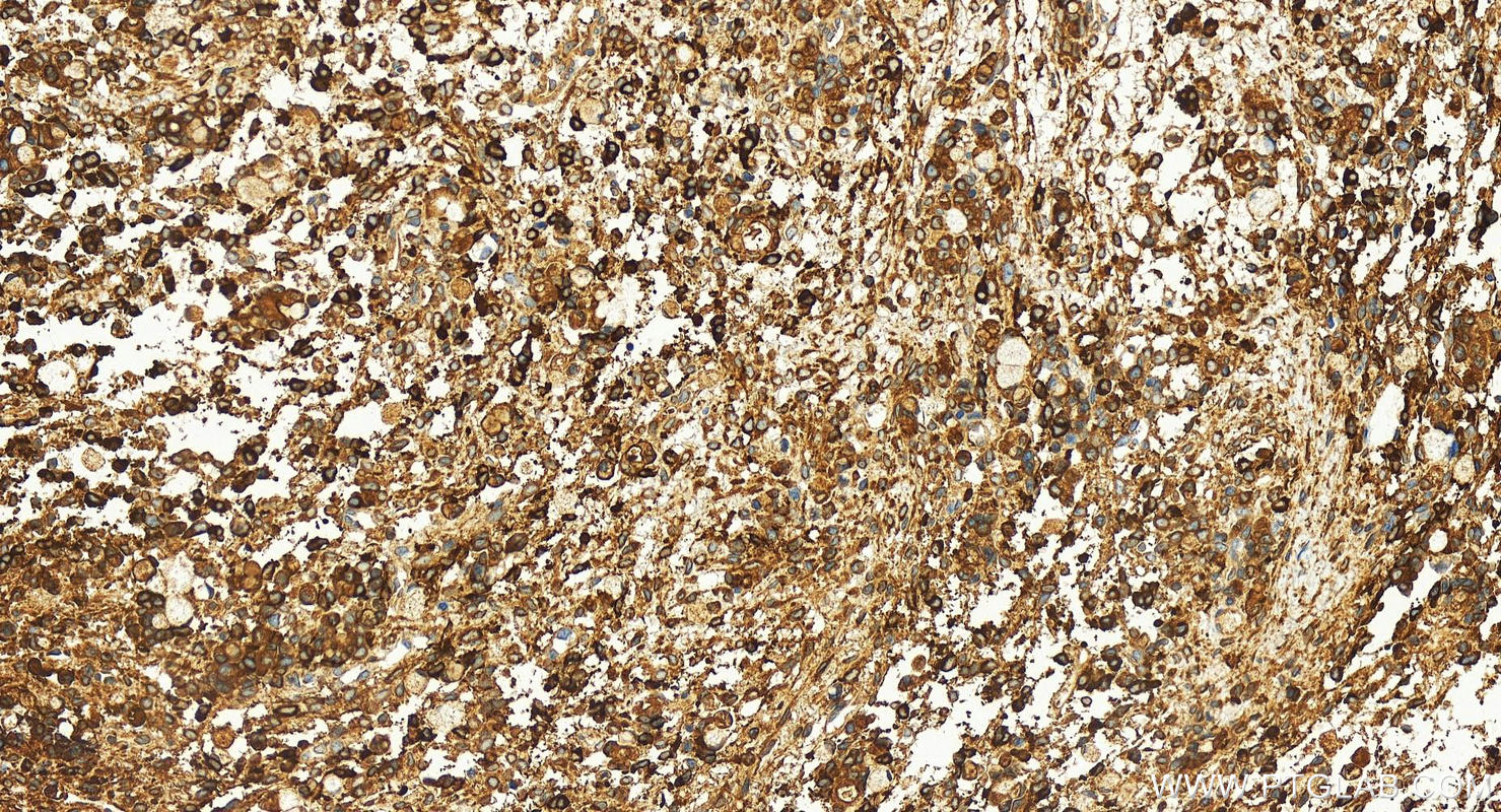 Immunohistochemistry (IHC) staining of human ovary cancer tissue using FDFT1 Polyclonal antibody (13128-1-AP)