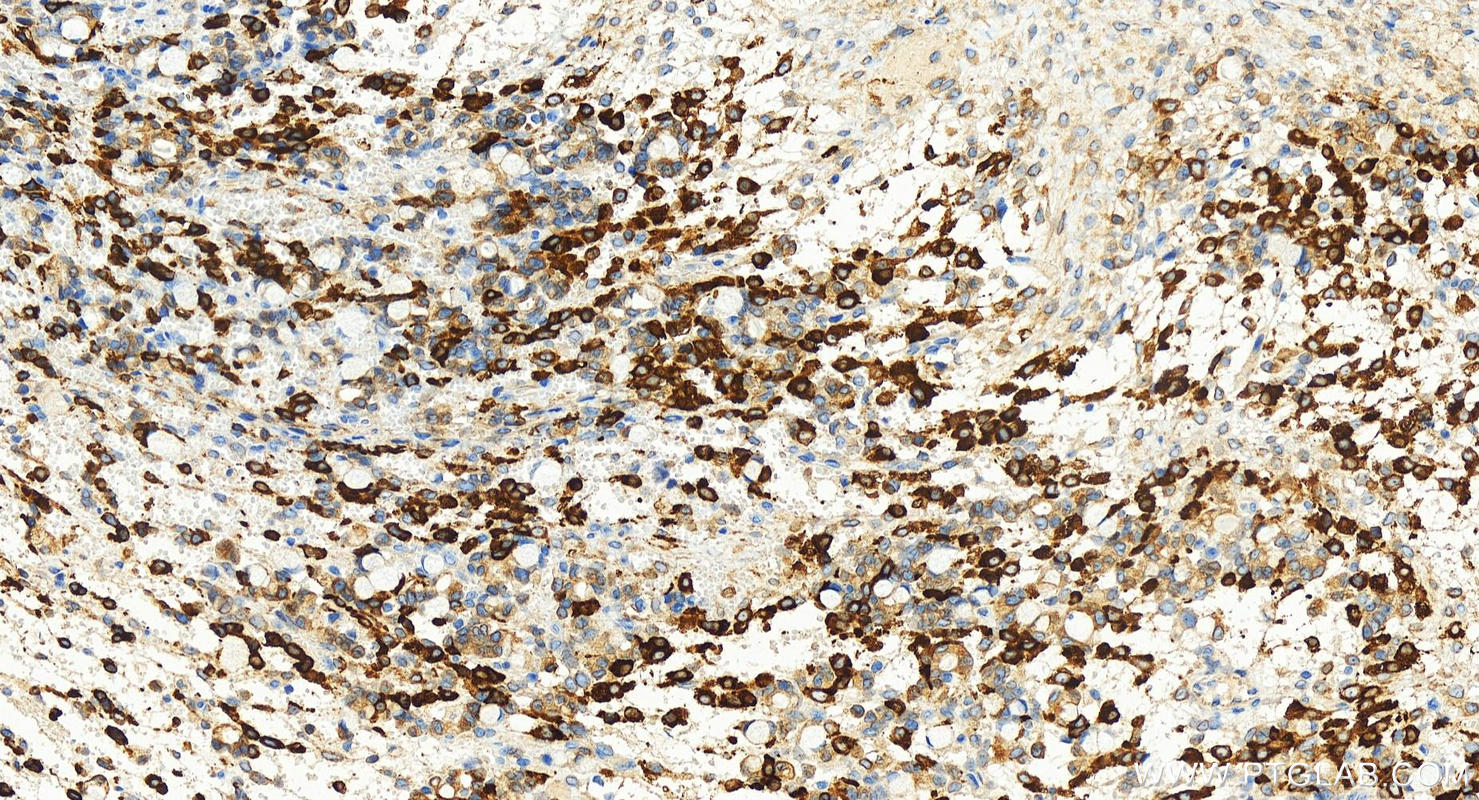 Immunohistochemistry (IHC) staining of human ovary cancer tissue using FDFT1 Recombinant antibody (83020-1-RR)