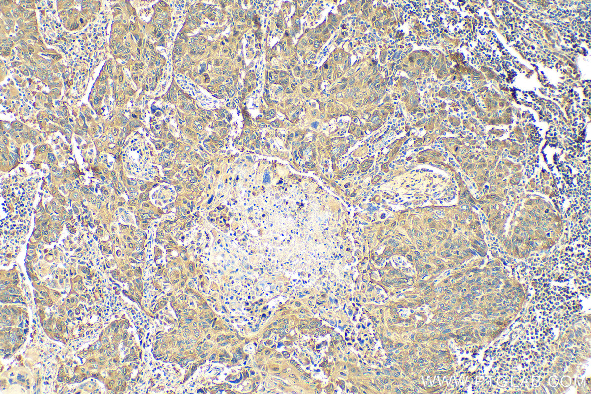 Immunohistochemistry (IHC) staining of human lung cancer tissue using P62,SQSTM1 Polyclonal antibody (18420-1-AP)