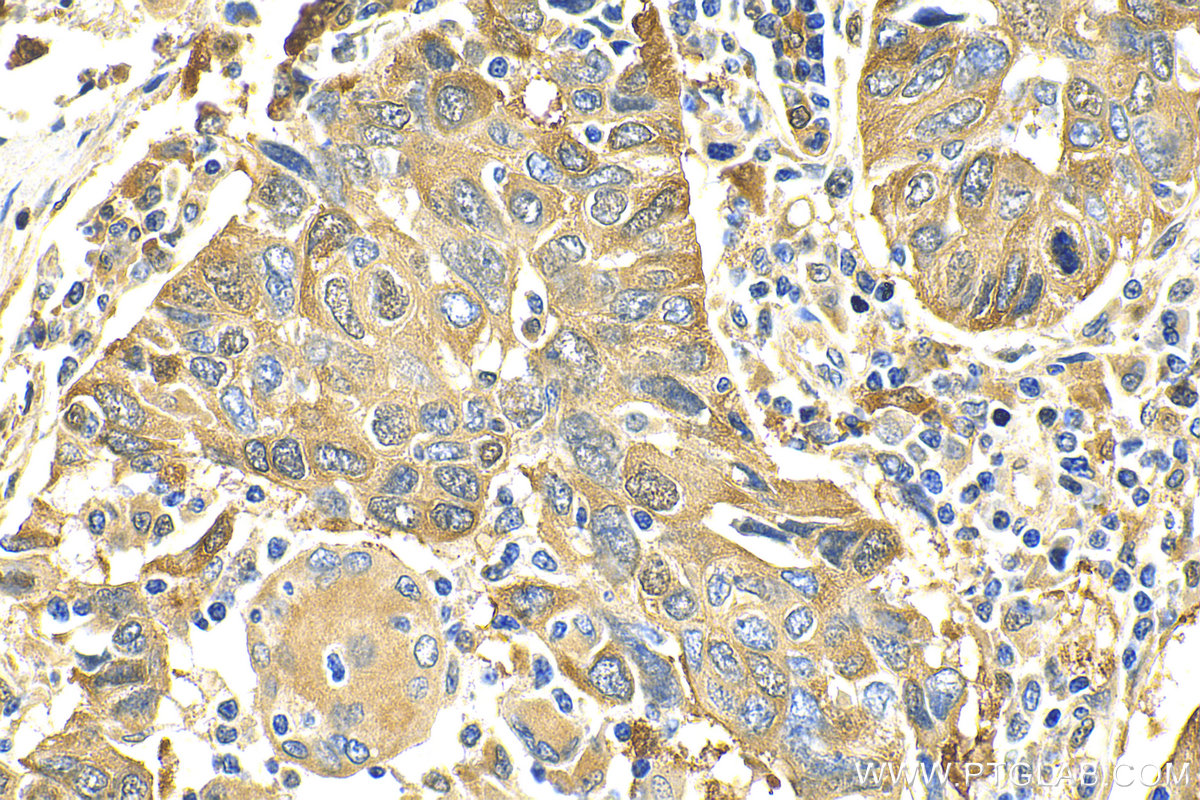 Immunohistochemistry (IHC) staining of human lung cancer tissue using P62,SQSTM1 Polyclonal antibody (18420-1-AP)