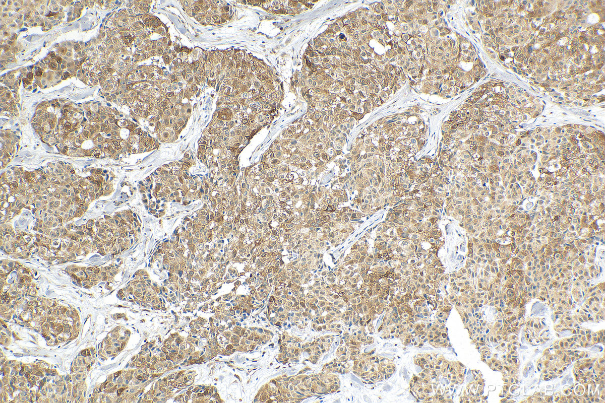 Immunohistochemistry (IHC) staining of human lung cancer tissue using P62,SQSTM1 Polyclonal antibody (18420-1-AP)