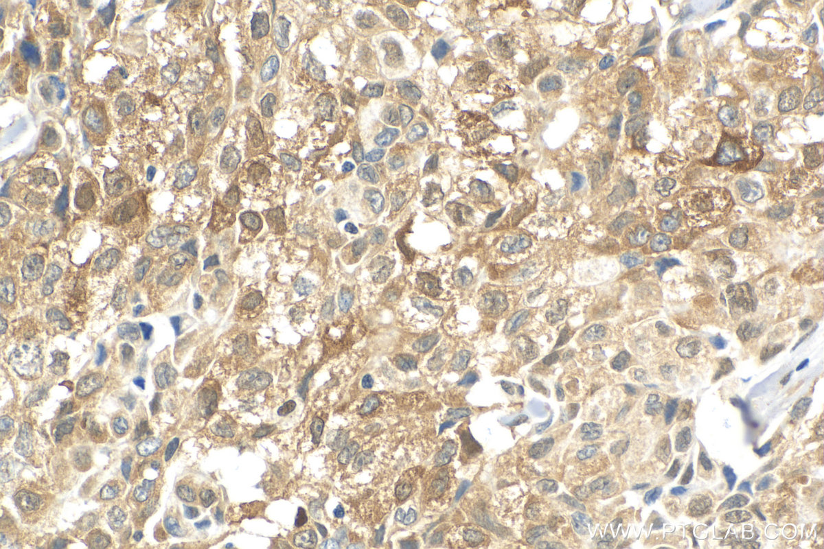 Immunohistochemistry (IHC) staining of human lung cancer tissue using P62,SQSTM1 Polyclonal antibody (18420-1-AP)