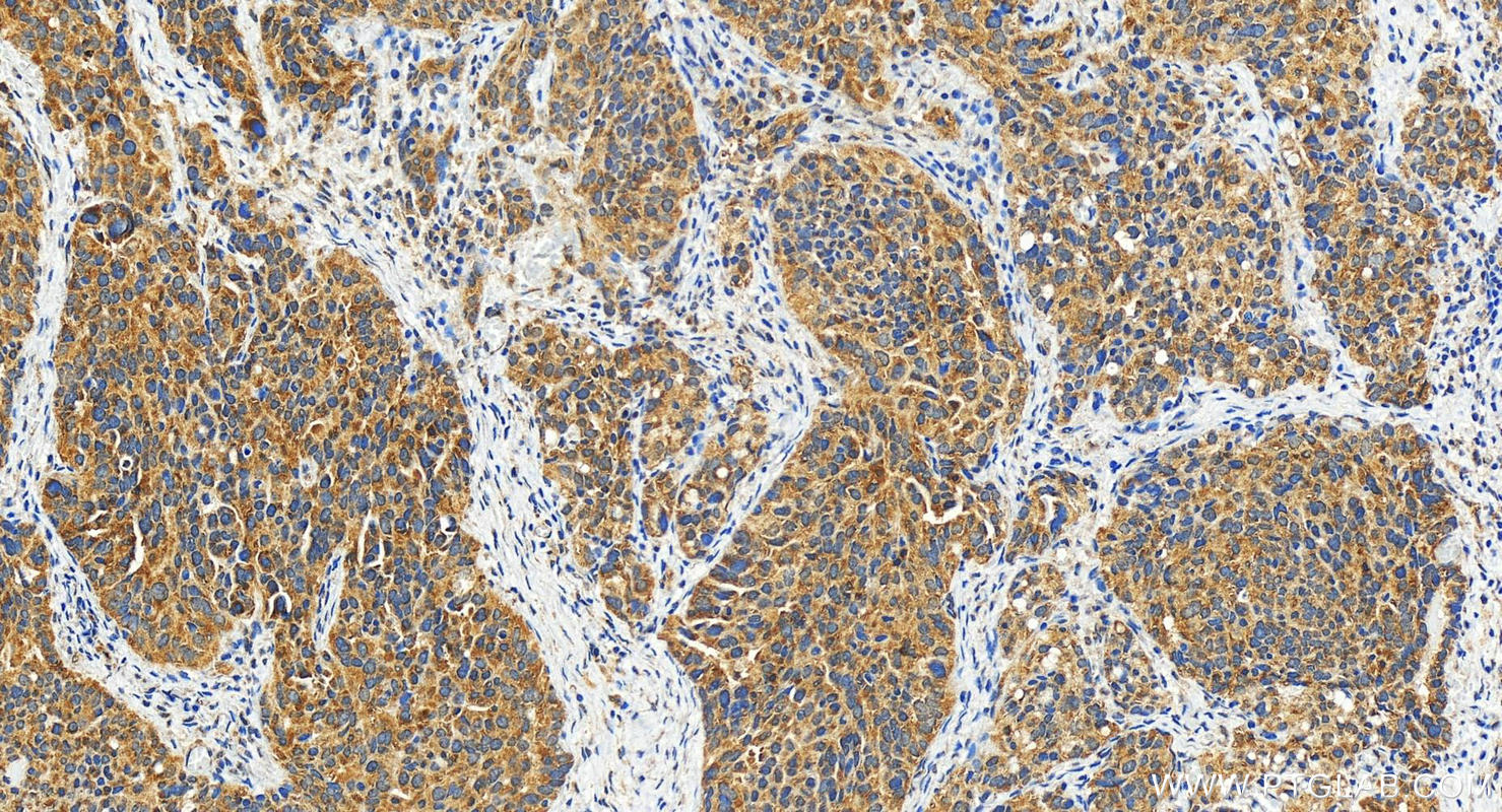 Immunohistochemistry (IHC) staining of human ovary cancer tissue using SRGAP3 Polyclonal antibody (29624-1-AP)