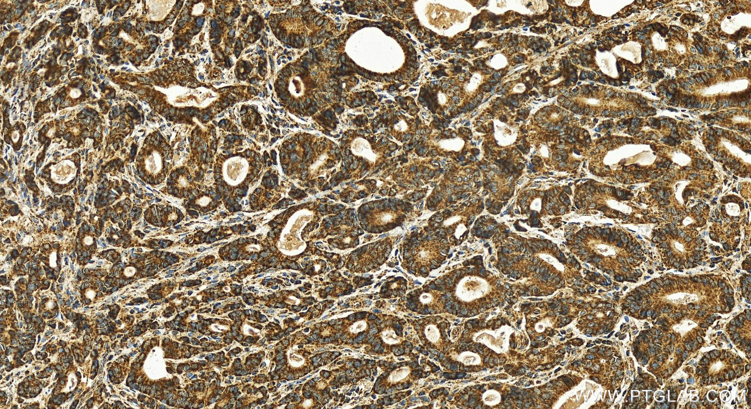 Immunohistochemistry (IHC) staining of human stomach cancer tissue using SSBP1 Polyclonal antibody (12212-1-AP)