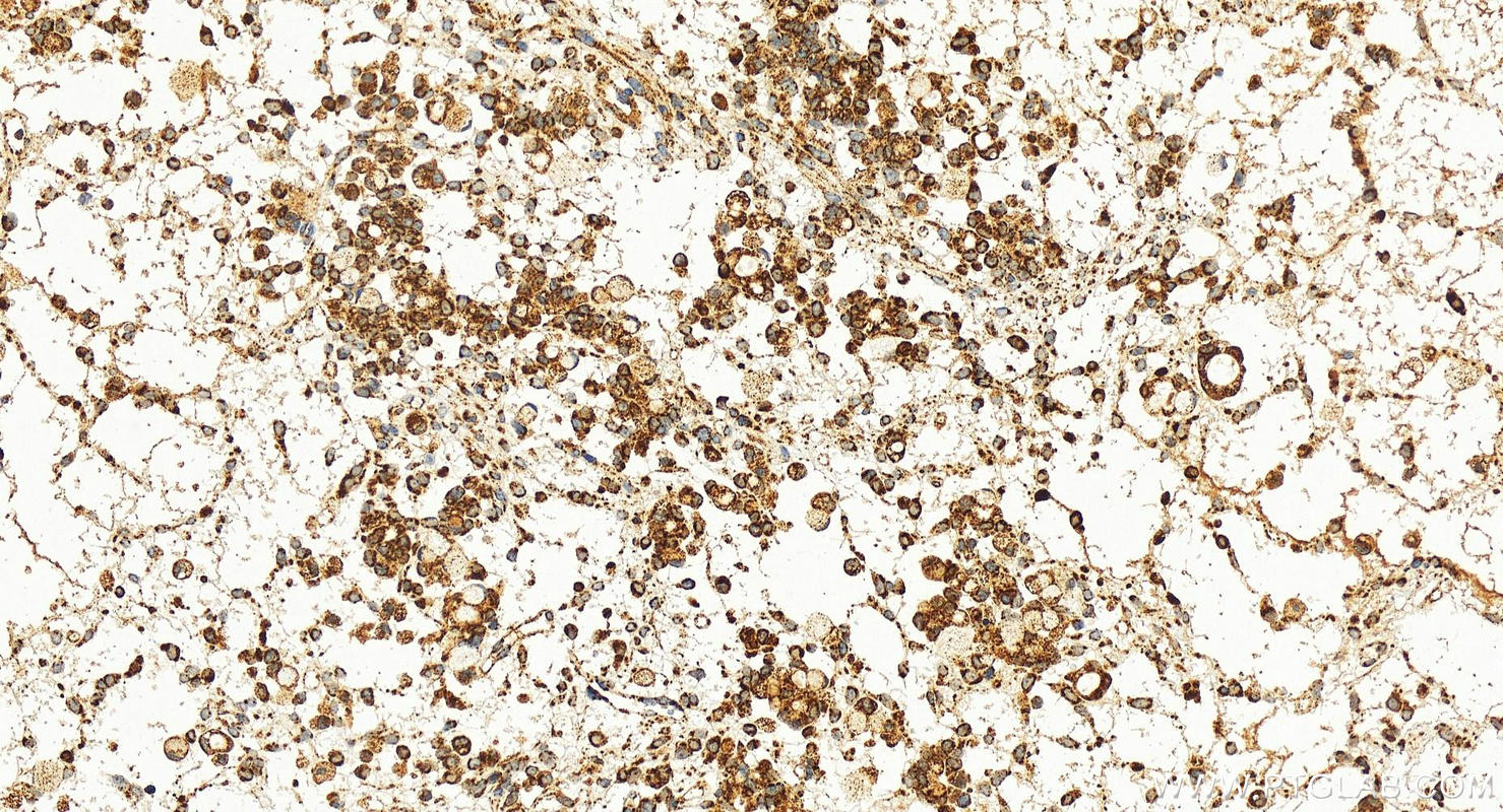 Immunohistochemistry (IHC) staining of human ovary cancer tissue using SSBP1 Polyclonal antibody (12212-1-AP)