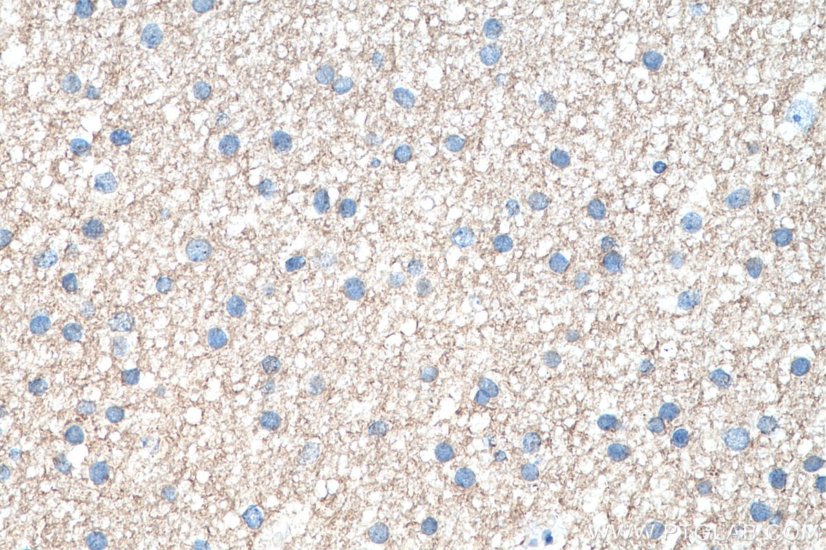Immunohistochemistry (IHC) staining of human gliomas tissue using SSTR3 Polyclonal antibody (20696-1-AP)