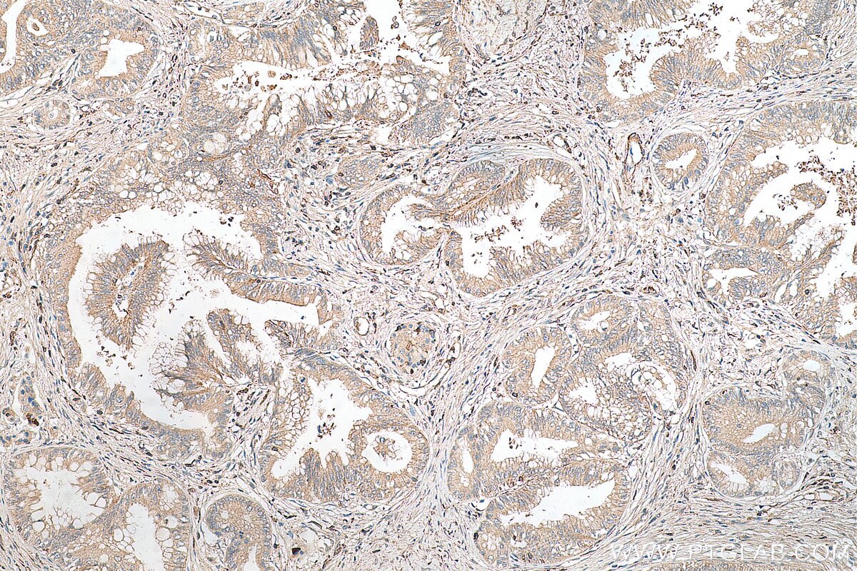 Immunohistochemistry (IHC) staining of human pancreas cancer tissue using SSTR3 Polyclonal antibody (20696-1-AP)
