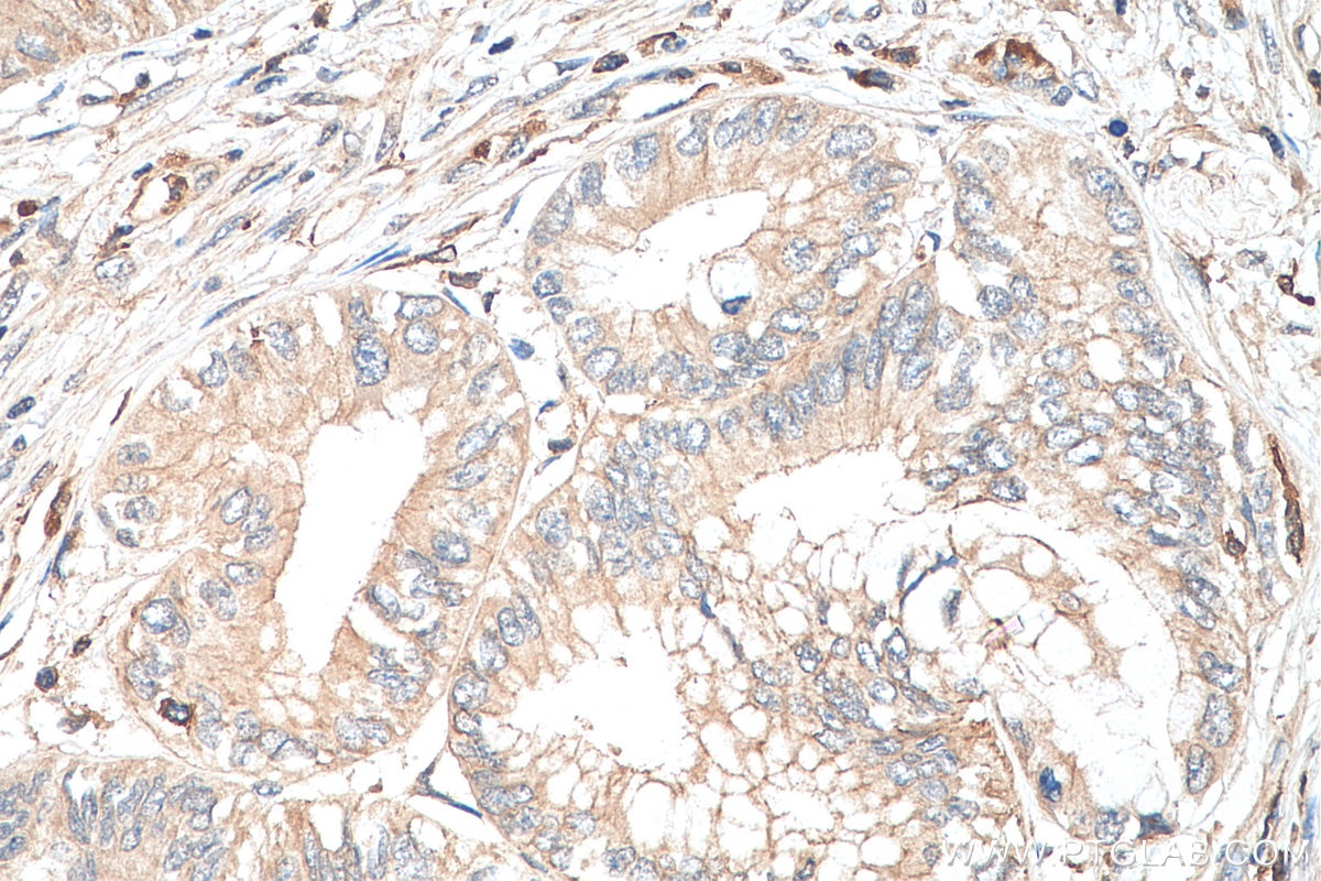 Immunohistochemistry (IHC) staining of human pancreas cancer tissue using SSTR3 Polyclonal antibody (20696-1-AP)