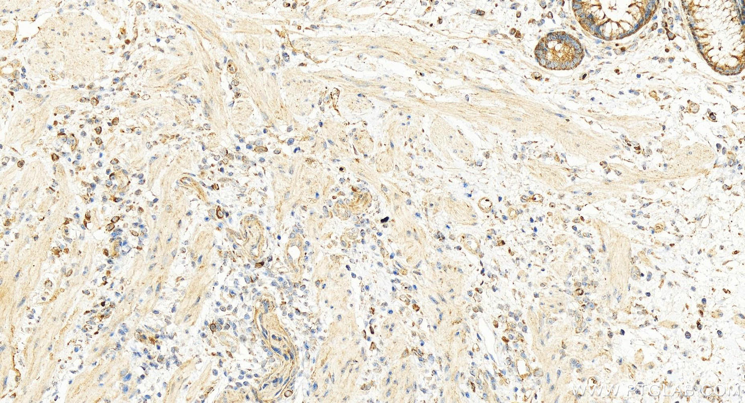 Immunohistochemistry (IHC) staining of human colon cancer tissue using ST6GAL1 Polyclonal antibody (14355-1-AP)