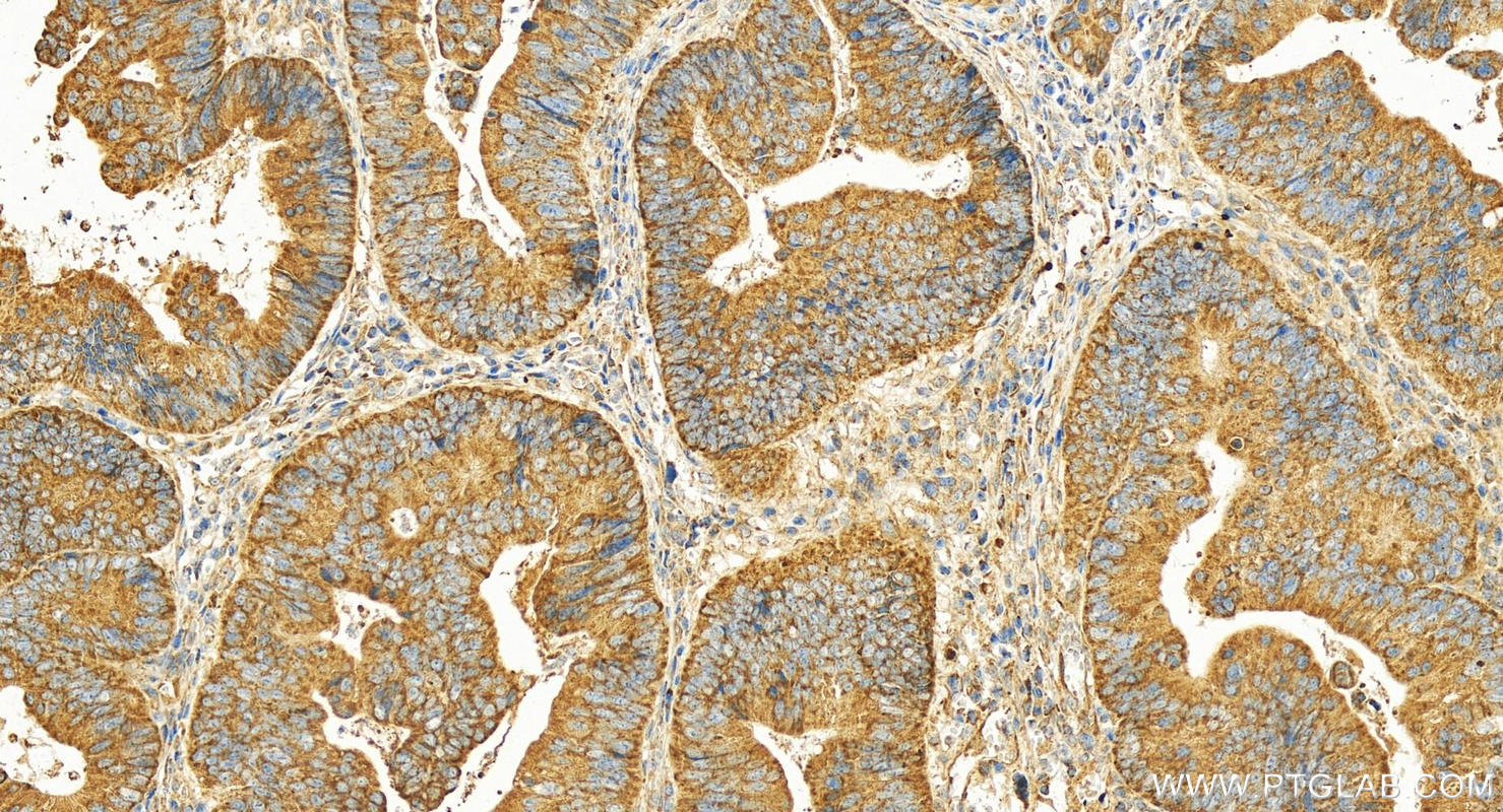 Immunohistochemistry (IHC) staining of human colon cancer tissue using ST6GAL1 Polyclonal antibody (14355-1-AP)