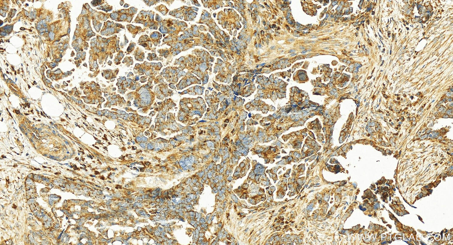 Immunohistochemistry (IHC) staining of human ovary cancer tissue using ST6GAL1 Polyclonal antibody (14355-1-AP)