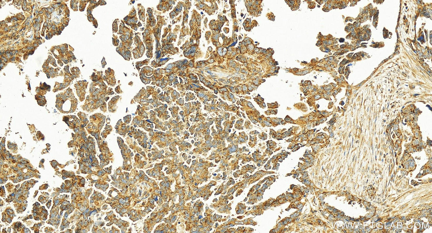 Immunohistochemistry (IHC) staining of human ovary cancer tissue using ST6GAL1 Polyclonal antibody (14355-1-AP)