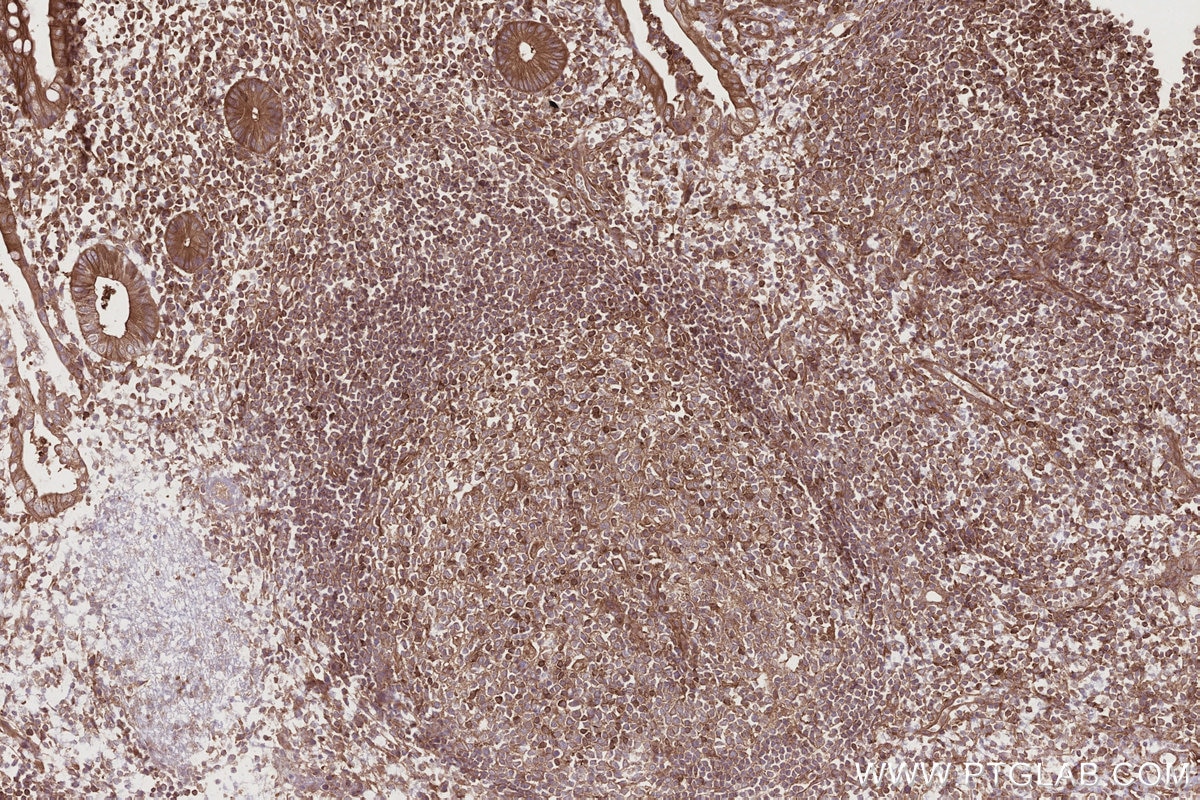 Immunohistochemistry (IHC) staining of human appendicitis tissue using STAM Polyclonal antibody (12434-1-AP)
