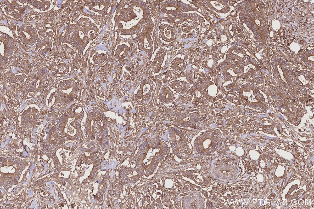 Immunohistochemistry (IHC) staining of human rectal cancer tissue using STAM Polyclonal antibody (12434-1-AP)
