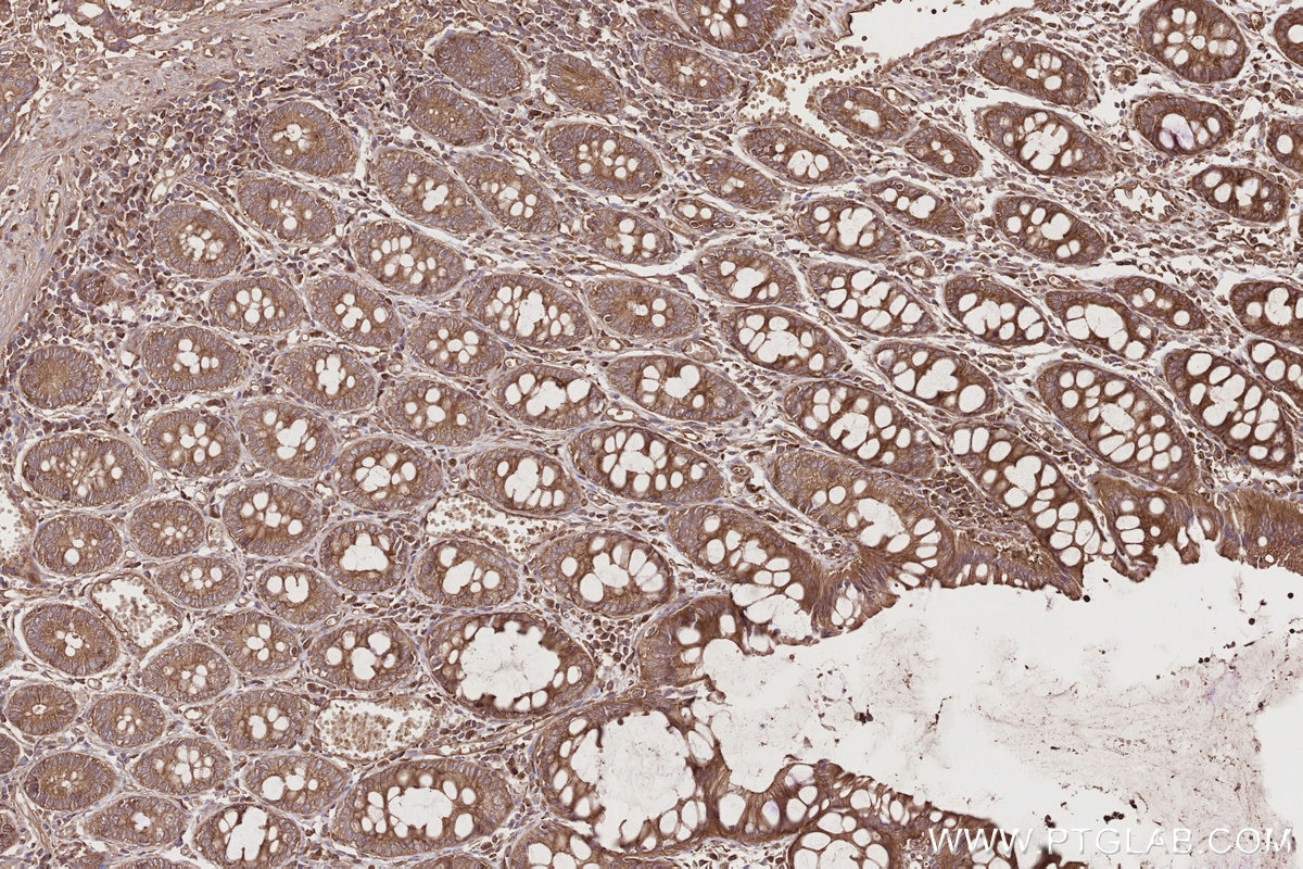 Immunohistochemistry (IHC) staining of human rectal cancer tissue using STAM Polyclonal antibody (12434-1-AP)