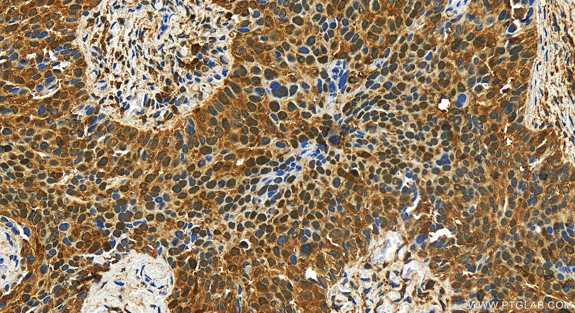 Immunohistochemistry (IHC) staining of human ovary cancer tissue using STAT1 Polyclonal antibody (10144-2-AP)