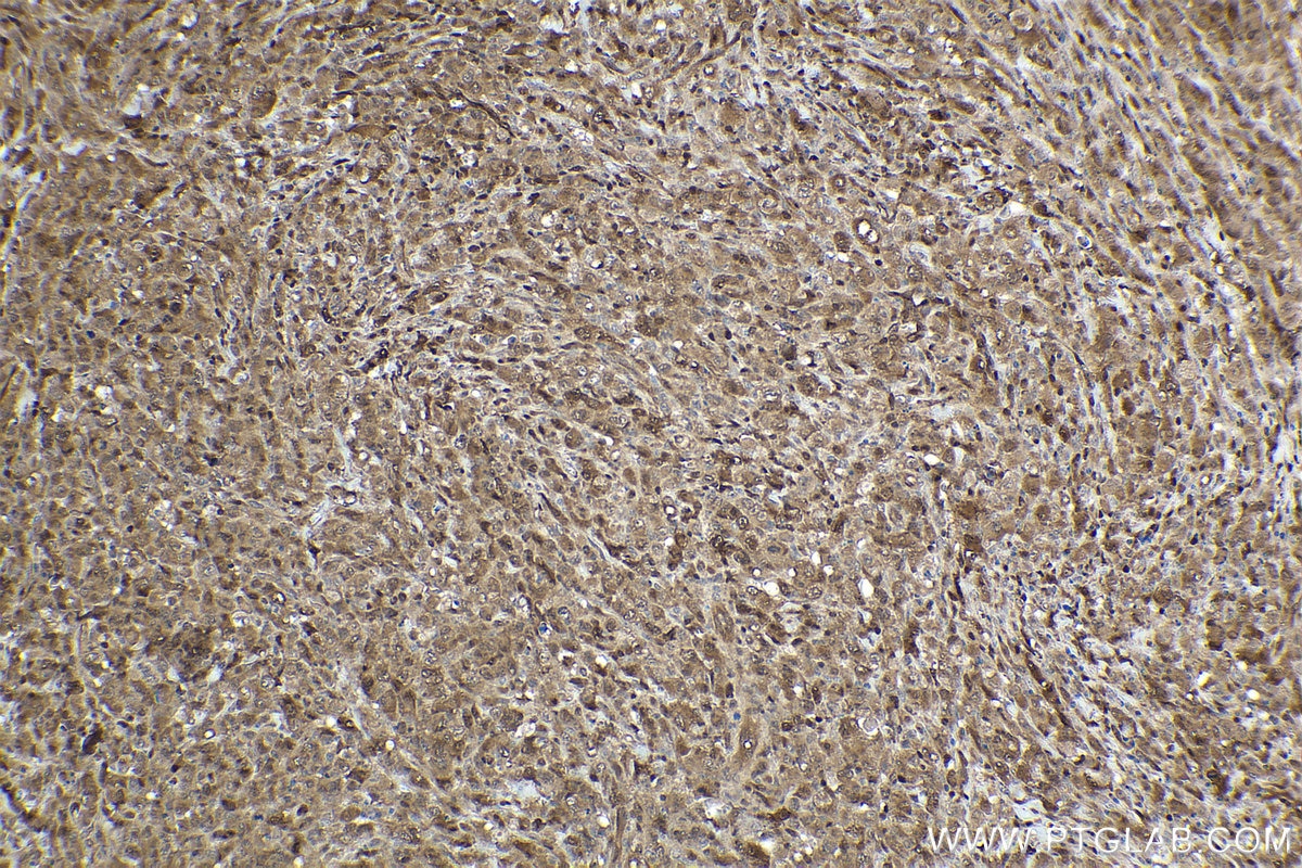 Immunohistochemistry (IHC) staining of human lymphoma tissue using STAT5A Monoclonal antibody (66459-1-Ig)