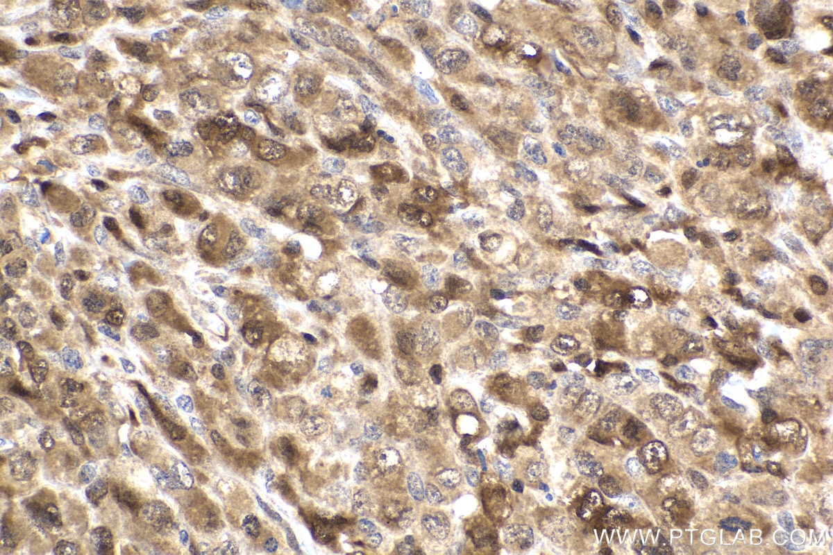 Immunohistochemistry (IHC) staining of human lymphoma tissue using STAT5A Monoclonal antibody (66459-1-Ig)