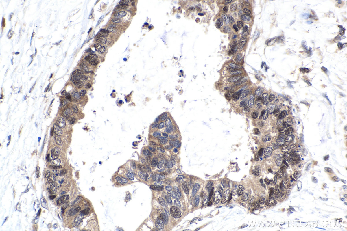 Immunohistochemistry (IHC) staining of human urothelial carcinoma tissue using STAT5A Monoclonal antibody (66459-1-Ig)