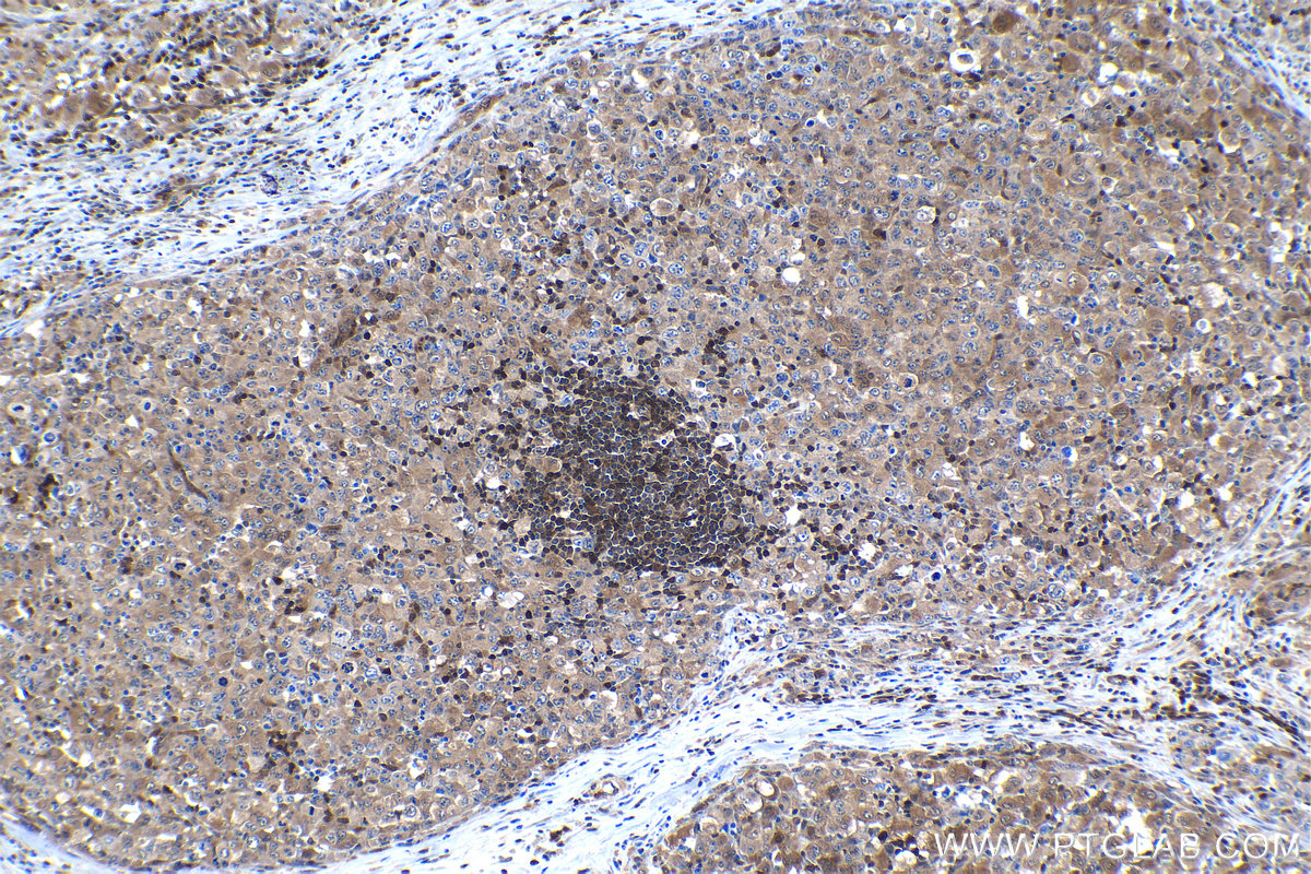 Immunohistochemistry (IHC) staining of human lymphoma tissue using STAT6 Monoclonal antibody (66717-1-Ig)