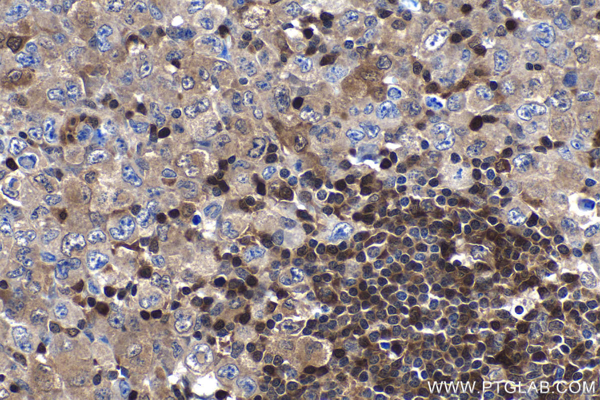 Immunohistochemistry (IHC) staining of human lymphoma tissue using STAT6 Monoclonal antibody (66717-1-Ig)