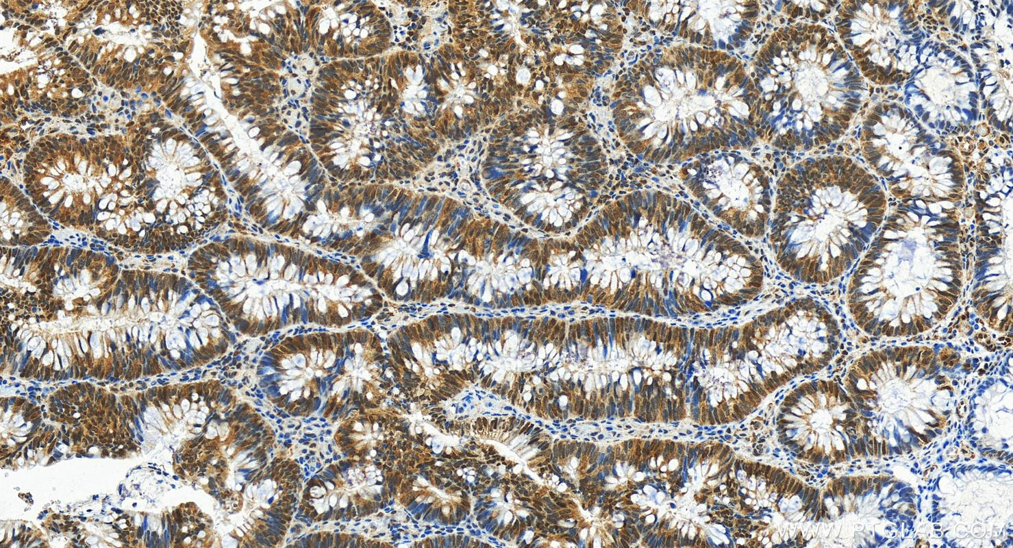 Immunohistochemistry (IHC) staining of human colon cancer tissue using STAT6 Recombinant antibody (82630-1-RR)