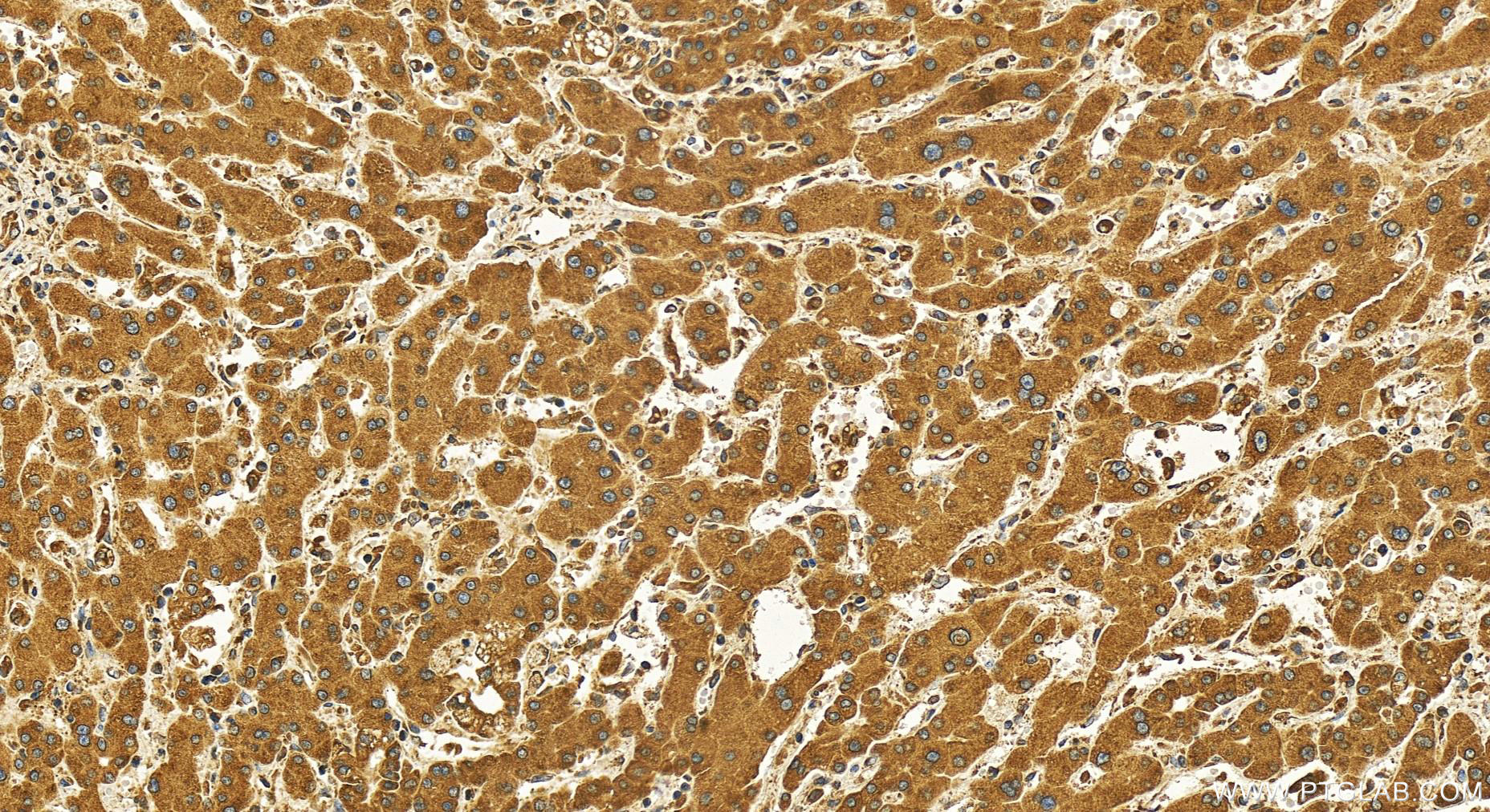 Immunohistochemistry (IHC) staining of human intrahepatic cholangiocarcinoma tissue using STIM1 Recombinant antibody (81156-1-RR)