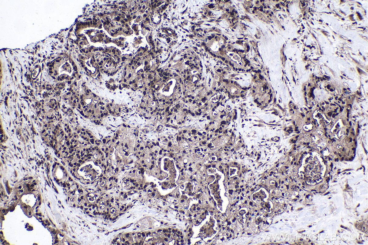 Immunohistochemistry (IHC) staining of human pancreas cancer tissue using STK3 Polyclonal antibody (12097-1-AP)