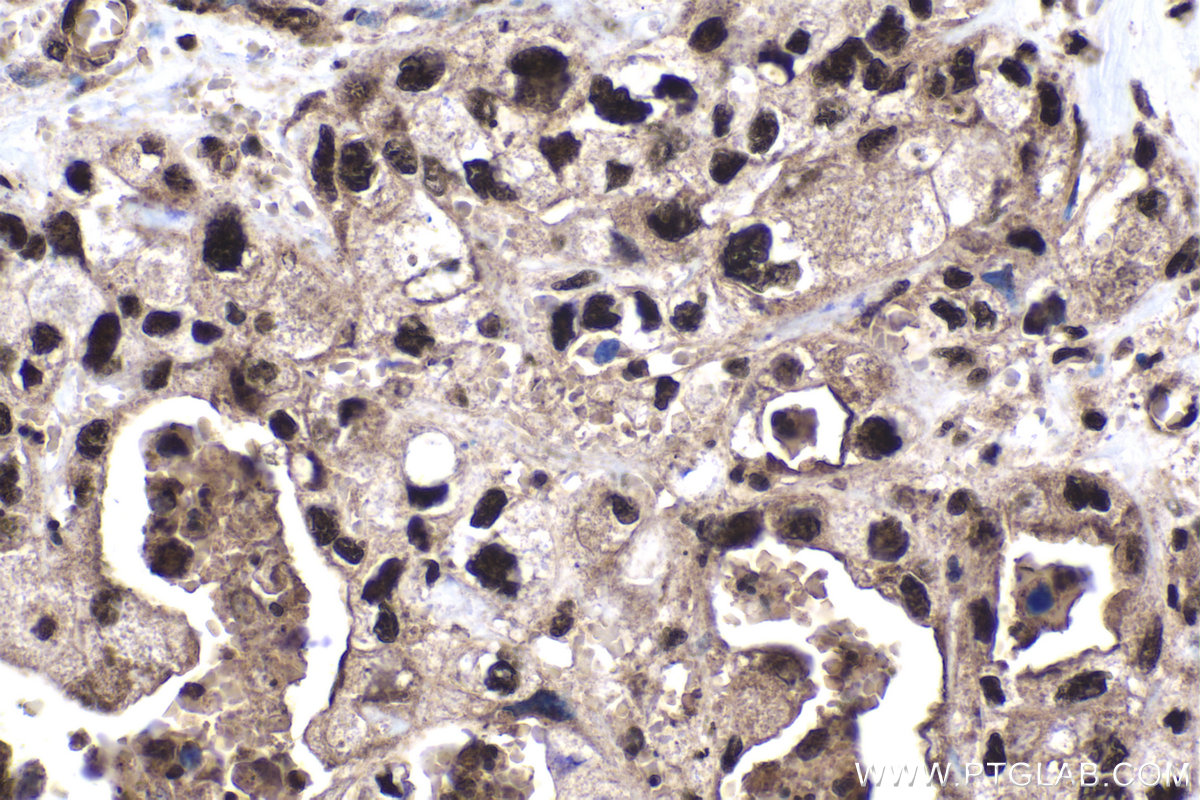 Immunohistochemistry (IHC) staining of human pancreas cancer tissue using STK3 Polyclonal antibody (12097-1-AP)