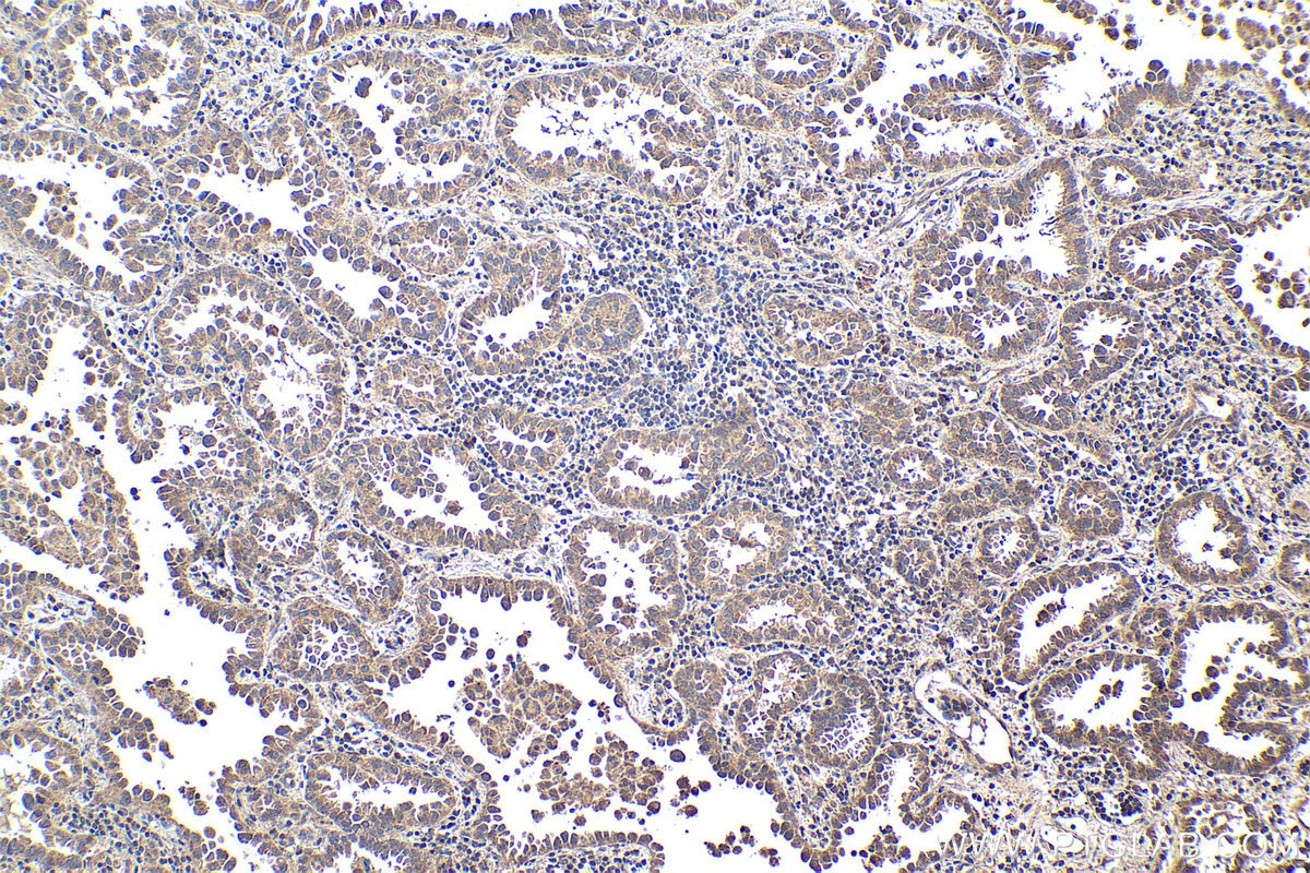 Immunohistochemistry (IHC) staining of human lung cancer tissue using STK36 Polyclonal antibody (12559-1-AP)