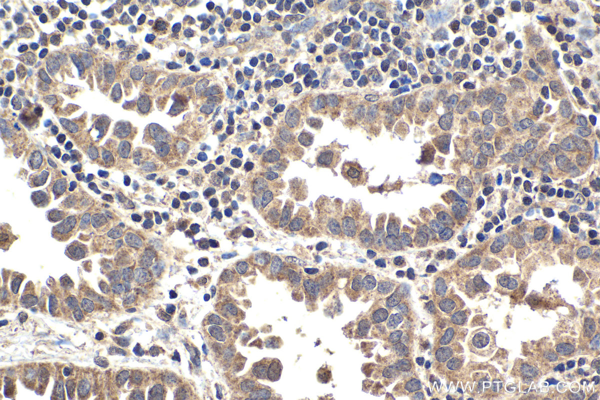 Immunohistochemistry (IHC) staining of human lung cancer tissue using STK36 Polyclonal antibody (12559-1-AP)