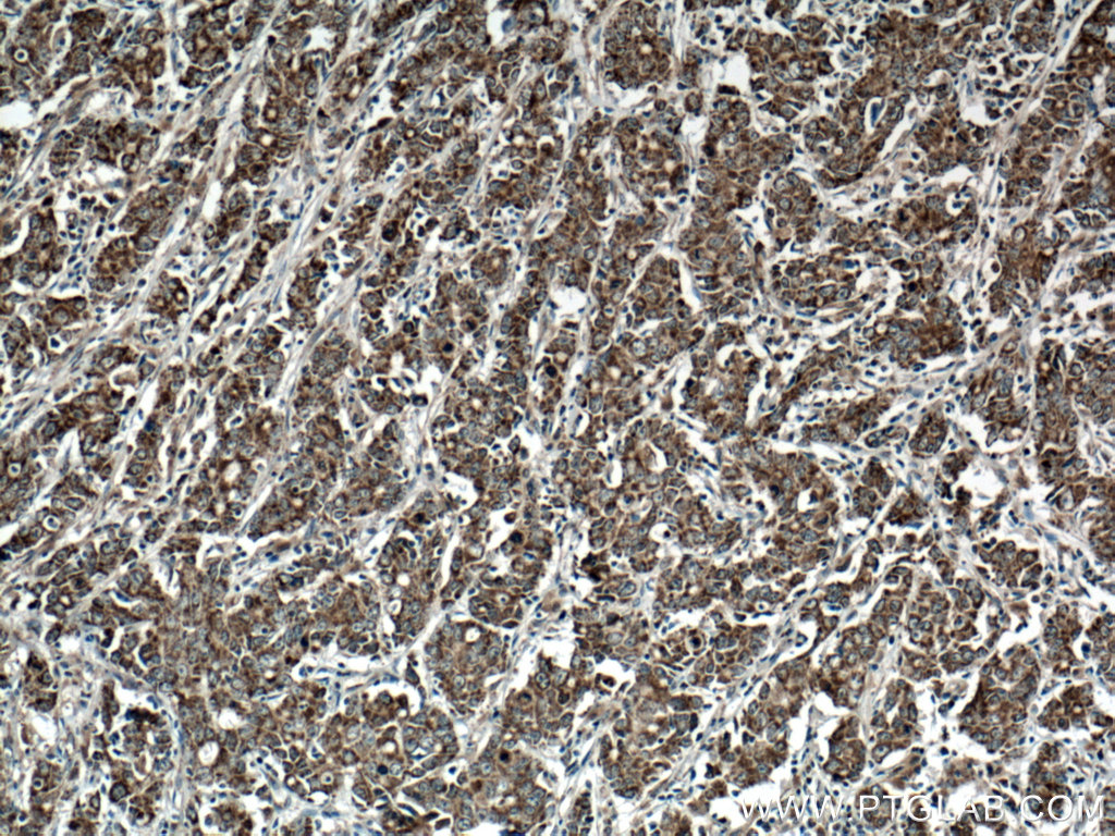 Immunohistochemistry (IHC) staining of human stomach cancer tissue using STOML2 Polyclonal antibody (10348-1-AP)