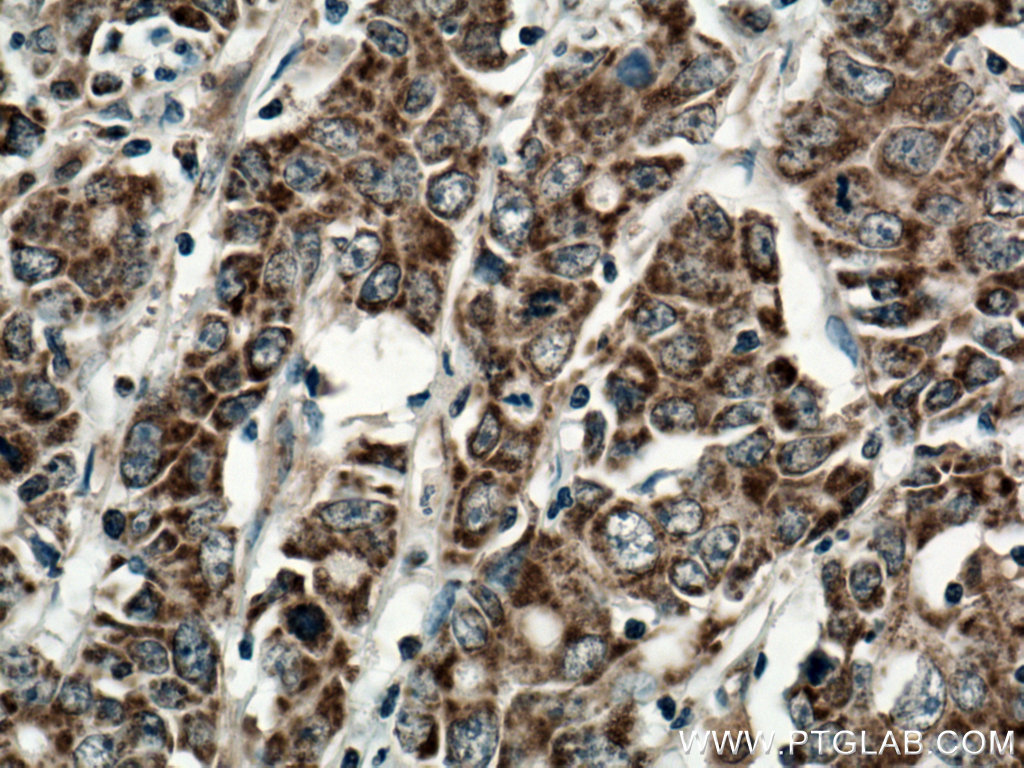 Immunohistochemistry (IHC) staining of human stomach cancer tissue using STOML2 Polyclonal antibody (10348-1-AP)