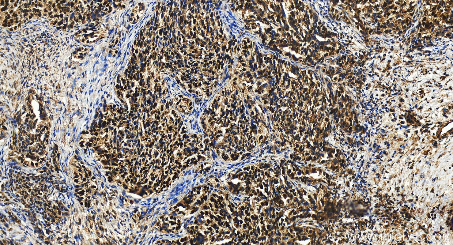 Immunohistochemistry (IHC) staining of human ovary cancer tissue using STRBP Polyclonal antibody (17362-1-AP)