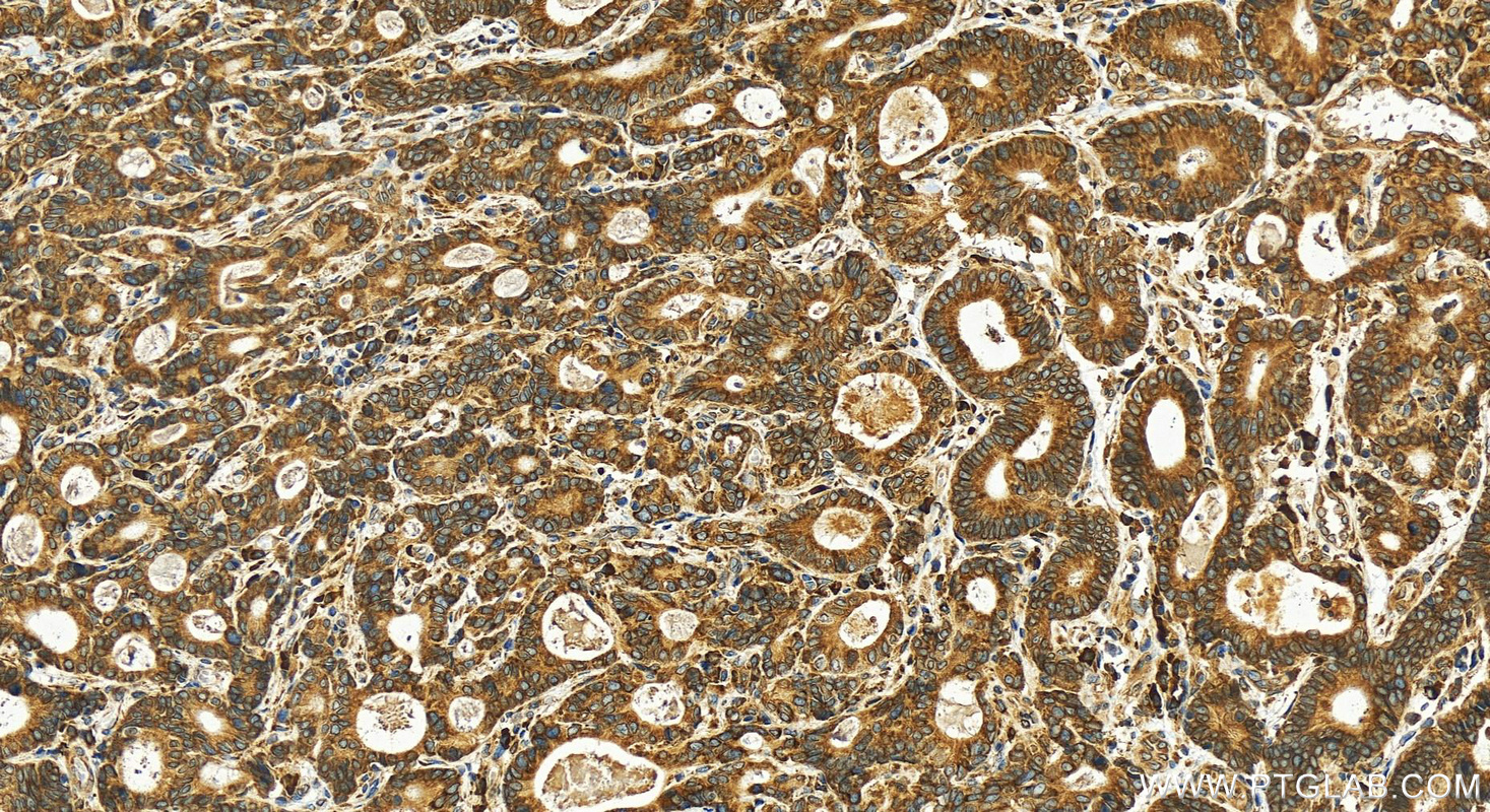 Immunohistochemistry (IHC) staining of human stomach cancer tissue using STT3A Polyclonal antibody (12034-1-AP)