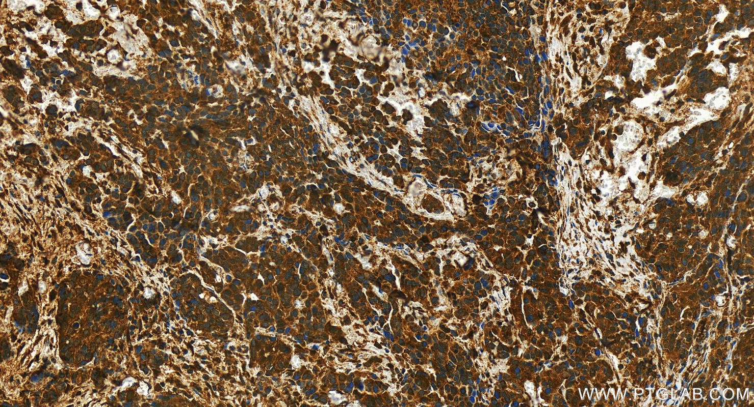 Immunohistochemistry (IHC) staining of human ovary cancer tissue using SULT1A1 Polyclonal antibody (10911-2-AP)