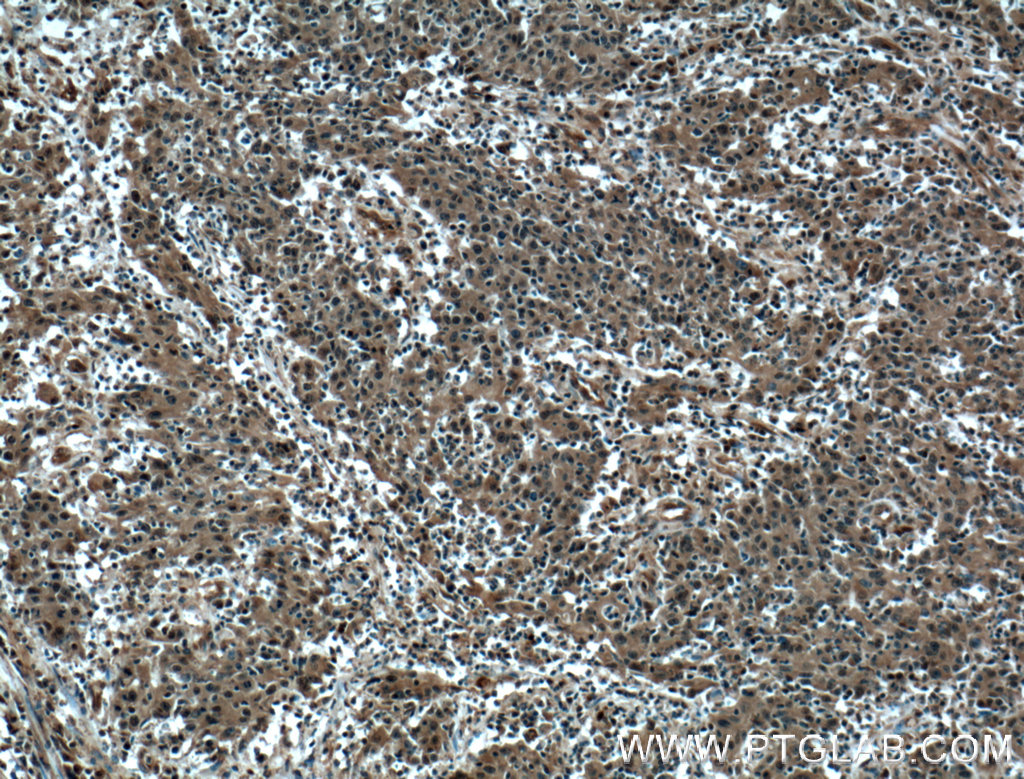 Immunohistochemistry (IHC) staining of human colon cancer tissue using SUMO2/3 Polyclonal antibody (10947-1-AP)